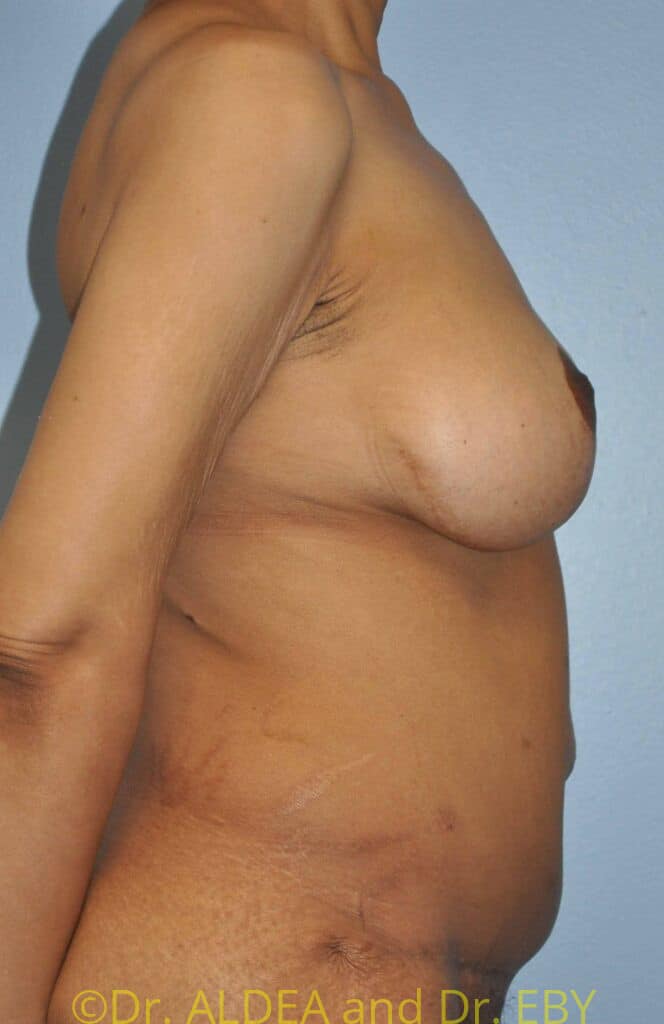 After Image: Mommy Makeover #446 - right-side