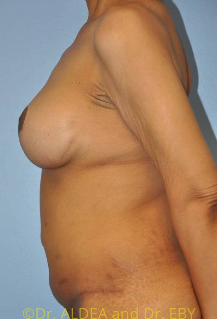 After Image: Mommy Makeover #446 - left-side