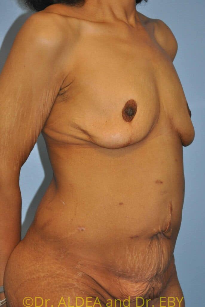 Before Image: Mommy Makeover #446 - right-front-oblique