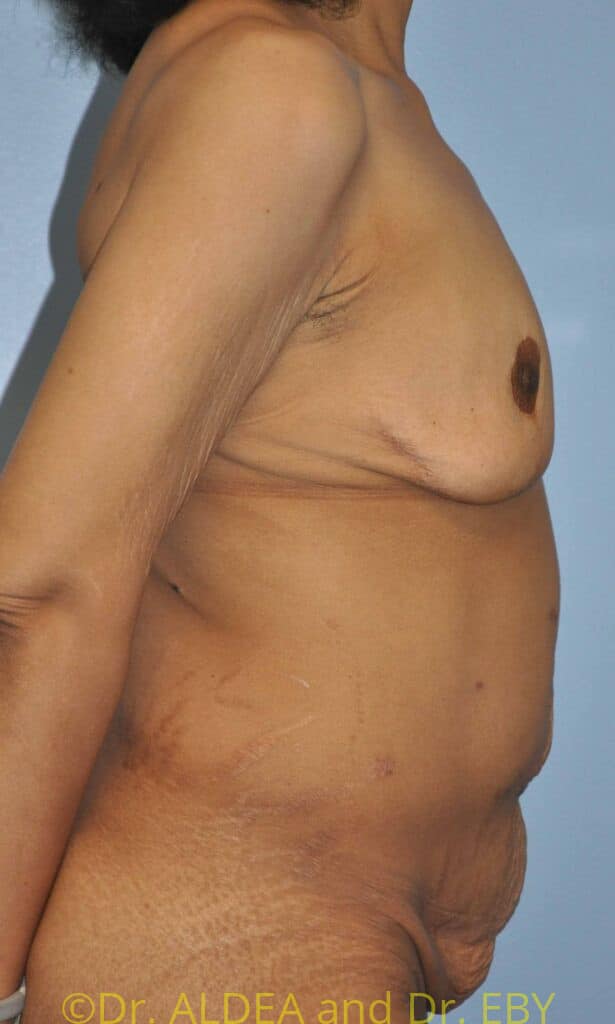 Before Image: Mommy Makeover #446 - right-side