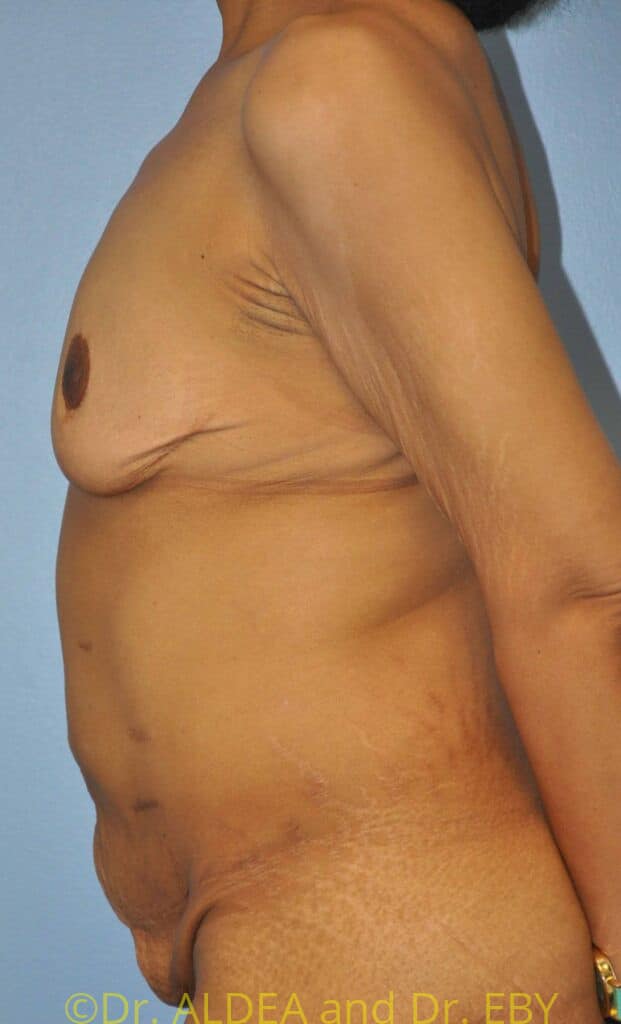 Before Image: Mommy Makeover #446 - left-side