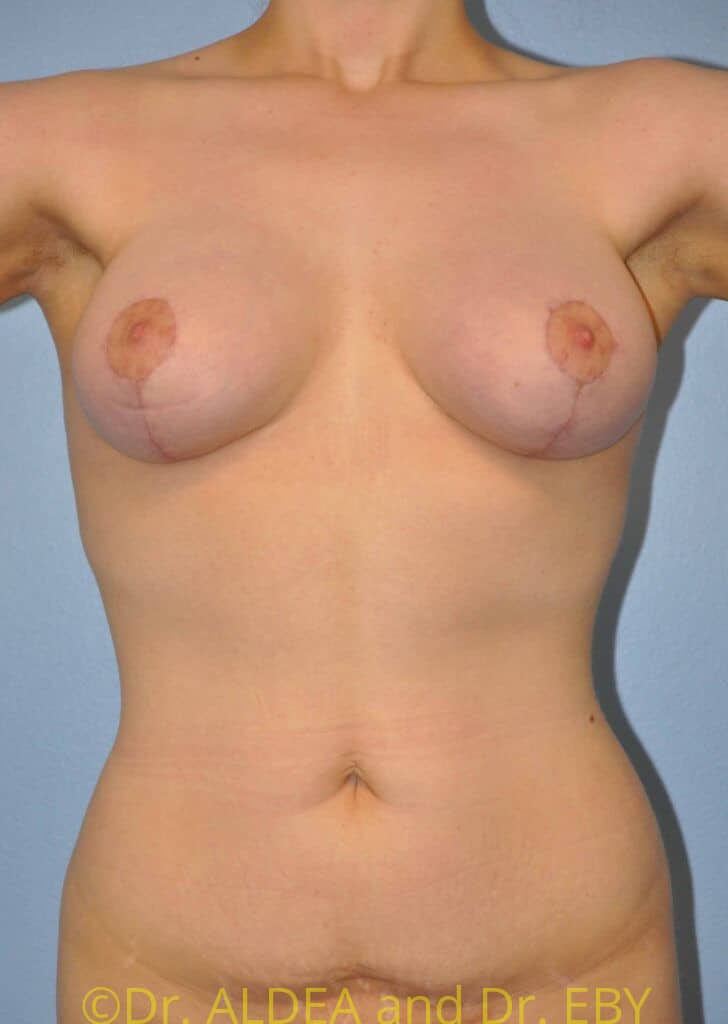 After Image: Breast Augmentation w/ Lift #992 - front