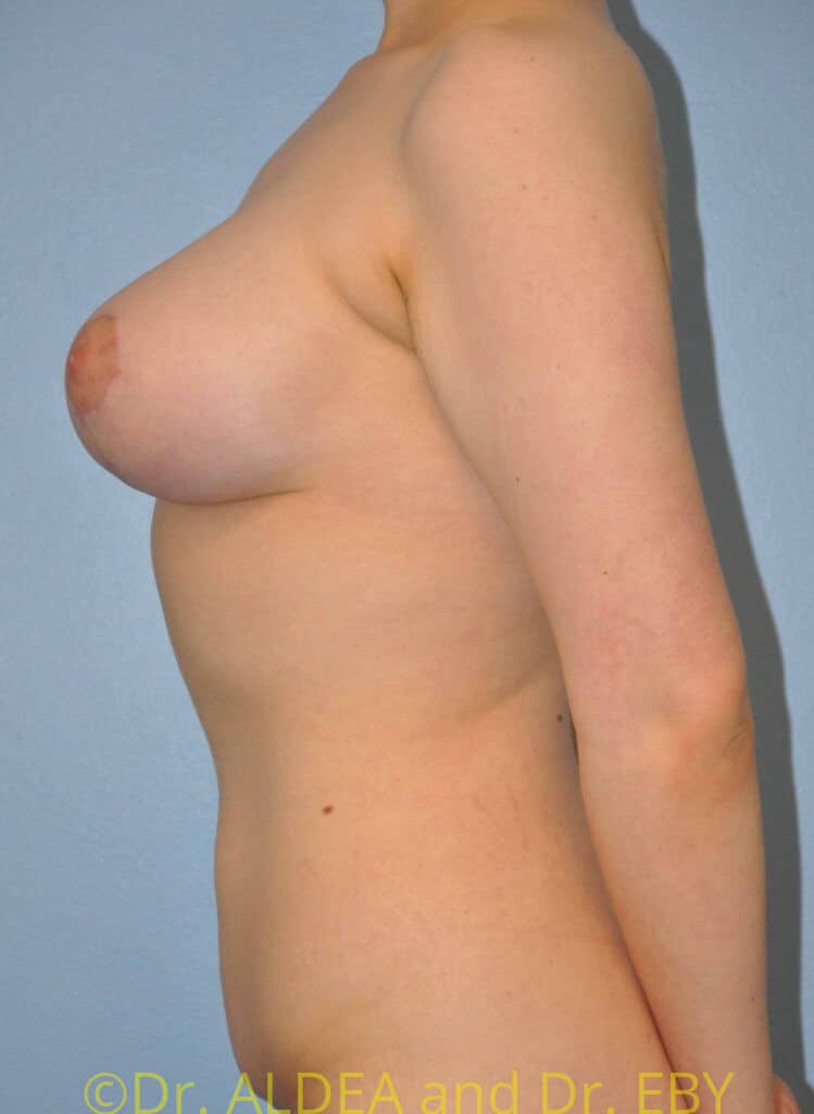 After Image: Breast Augmentation w/ Lift #992 - left-side