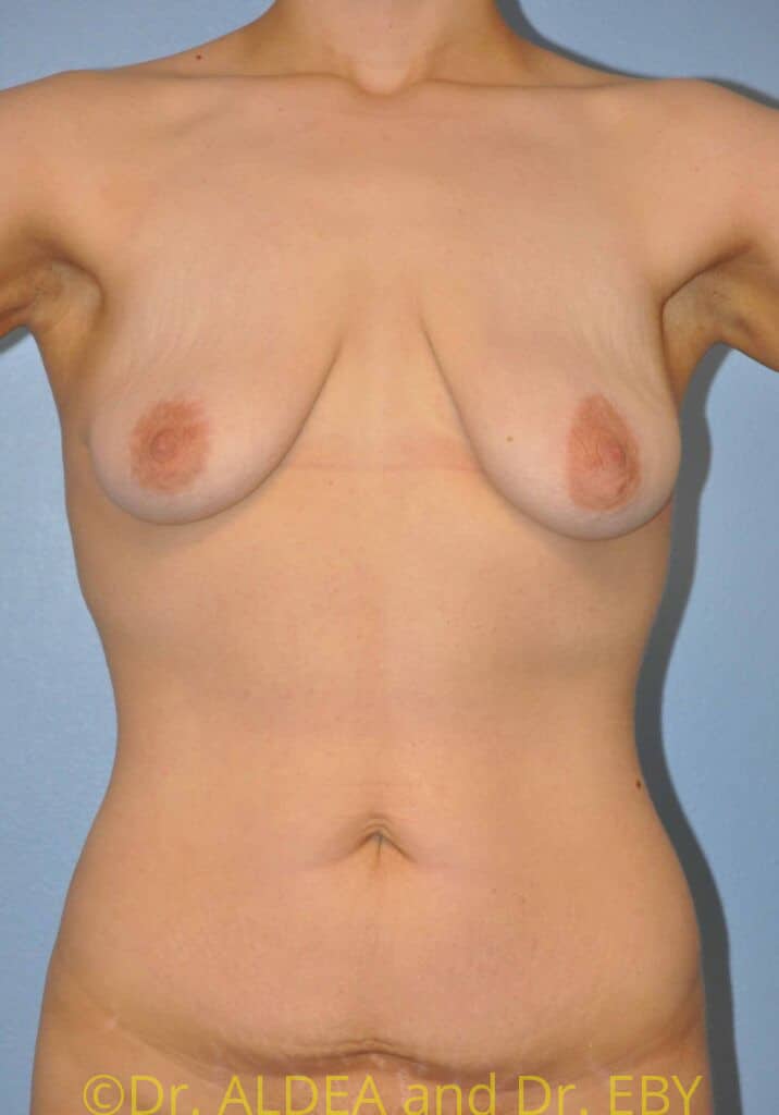 Before Image: Breast Augmentation w/ Lift #992 - front