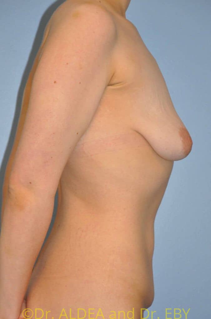Before Image: Breast Augmentation w/ Lift #992 - right-side