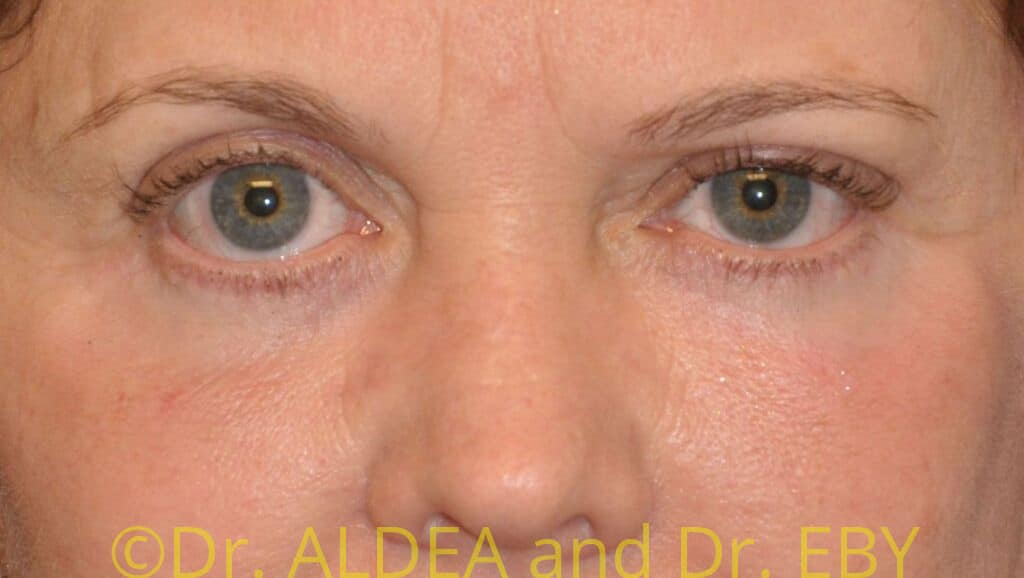 After Image: Blepharoplasty #974 - front
