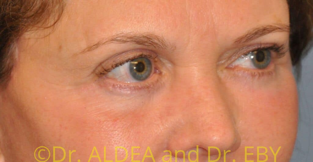 After Image: Blepharoplasty #974 - right-front-oblique