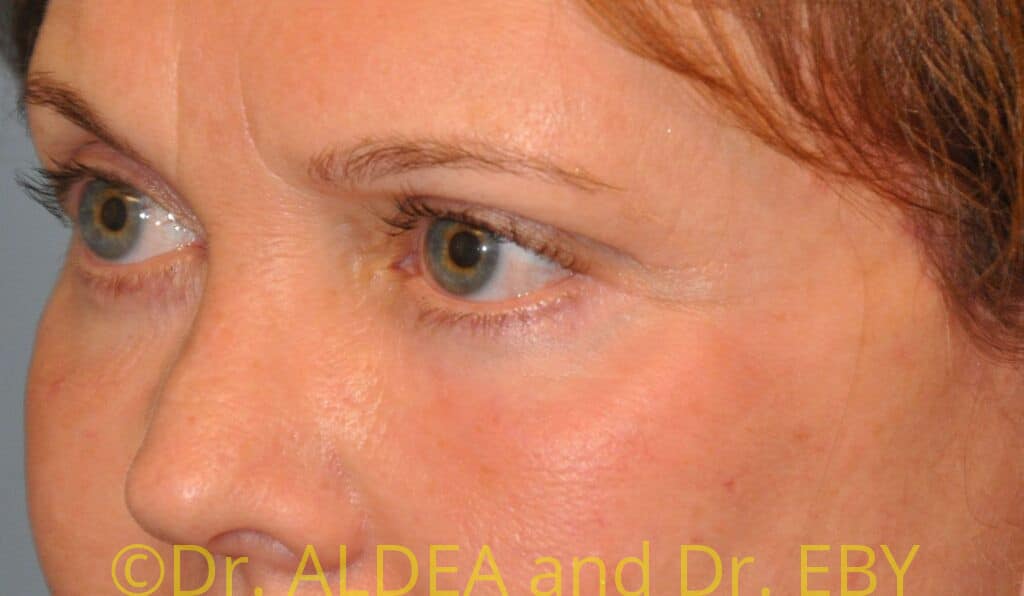 After Image: Blepharoplasty #974 - left-front-oblique