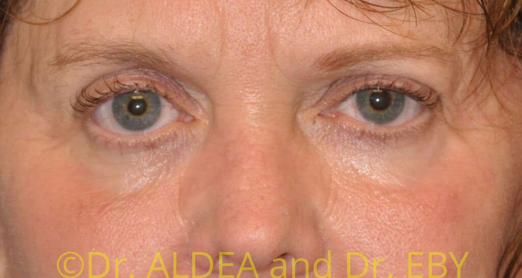 Before Image: Blepharoplasty #974 - front