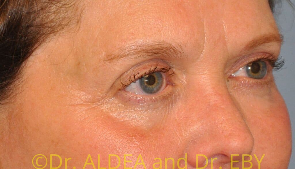 Before Image: Blepharoplasty #974 - right-front-oblique
