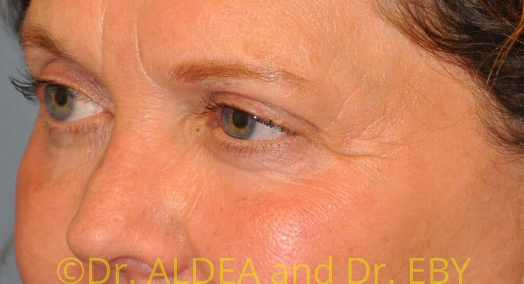 Before Image: Blepharoplasty #974 - left-front-oblique