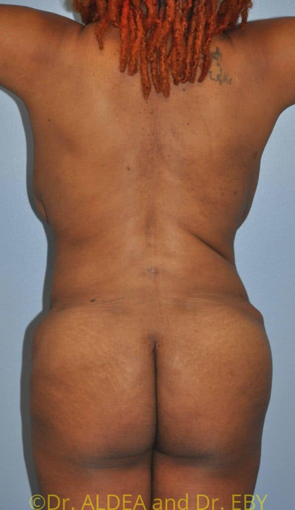 After Image: Back Scoop Liposuction #482 - back