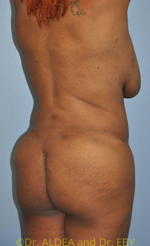 After Image: Back Scoop Liposuction #482 - right-back-oblique