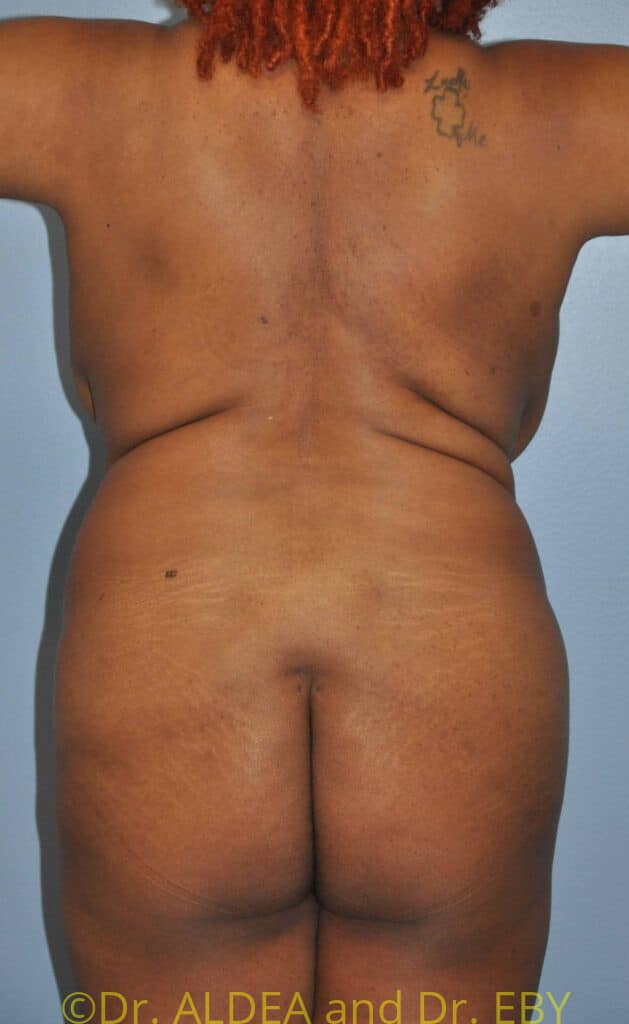 Before Image: Back Scoop Liposuction #482 - back