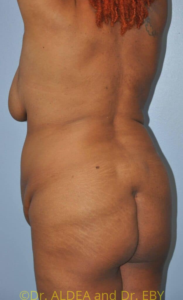 Before Image: Back Scoop Liposuction #482 - left-back-oblique