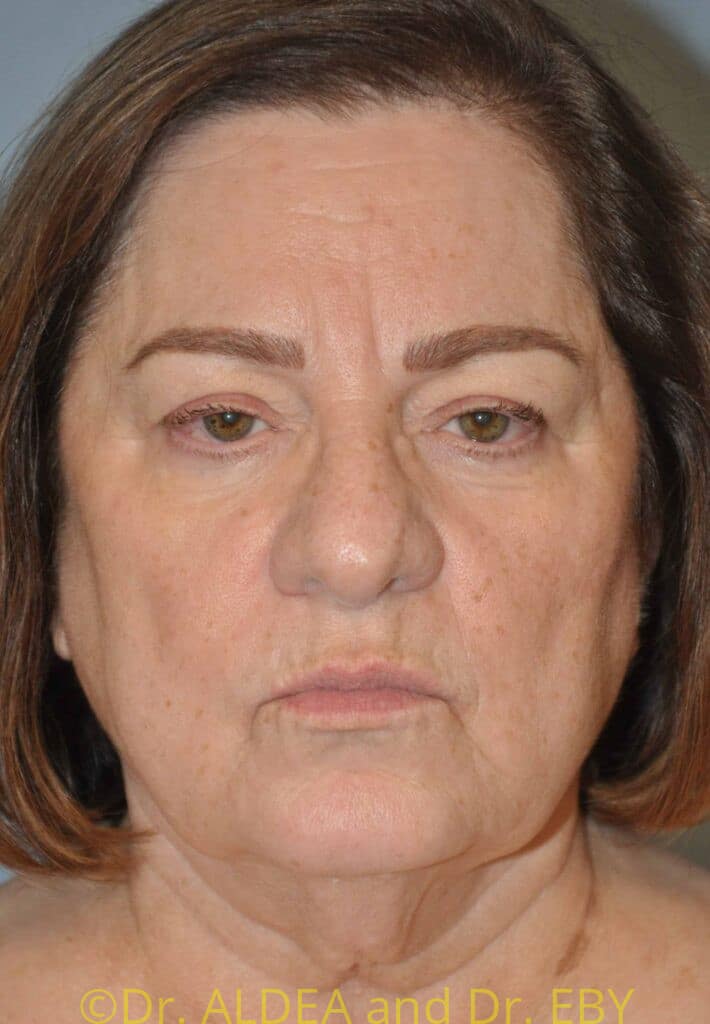 Before Image: Facelift #289 - front