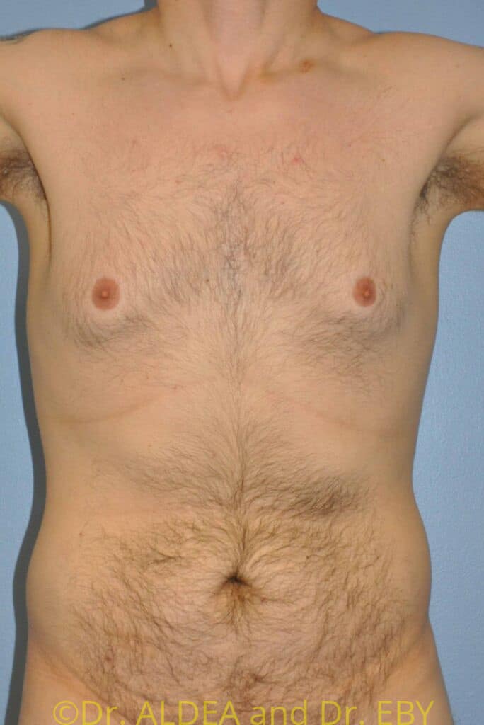 Before Image: Gynecomastia #242 - front