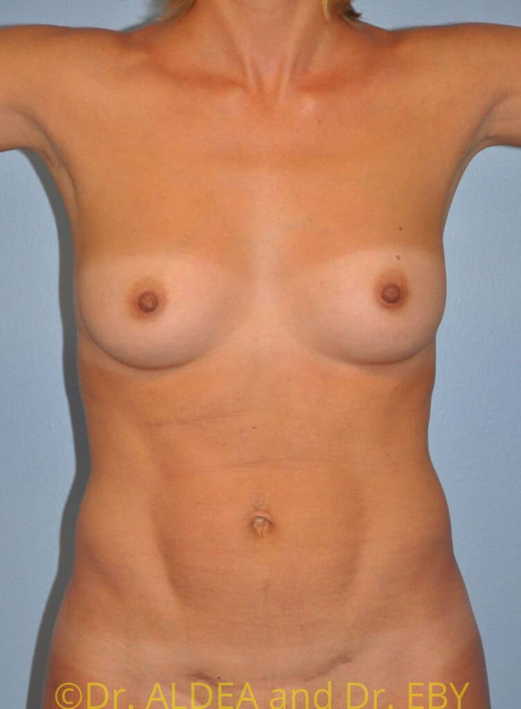 Before Image: Liposuction #975 - front