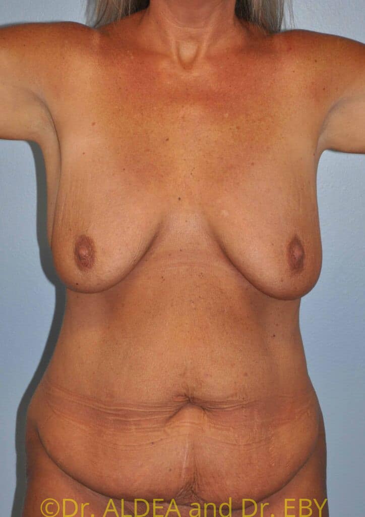 Before Image: Tummy Tuck #289 - front