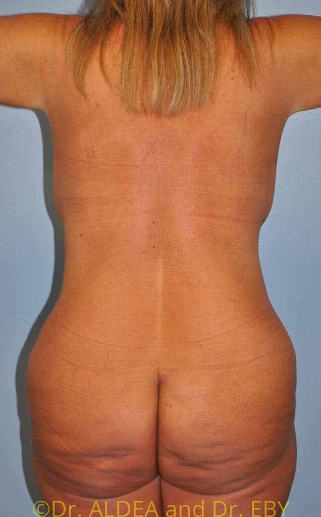 After Image: Tummy Tuck #289 - back