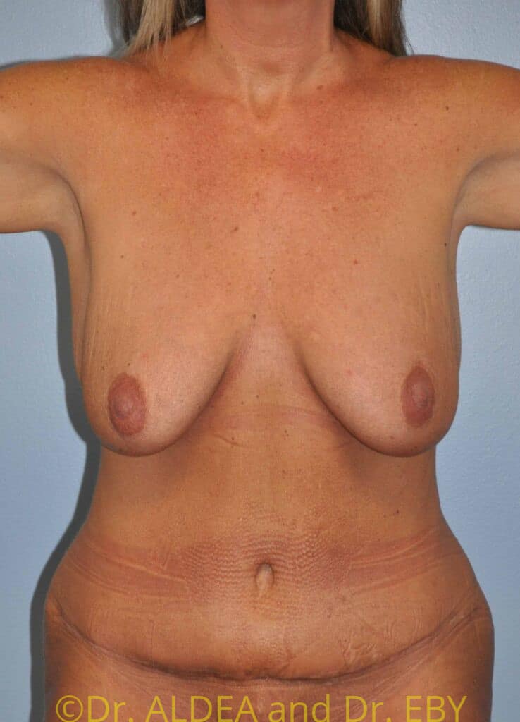 After Image: Tummy Tuck #289 - front