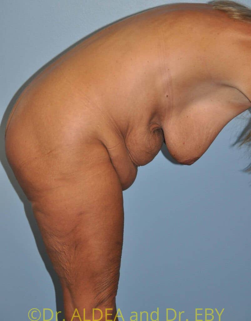 Before Image: Tummy Tuck #289 - other