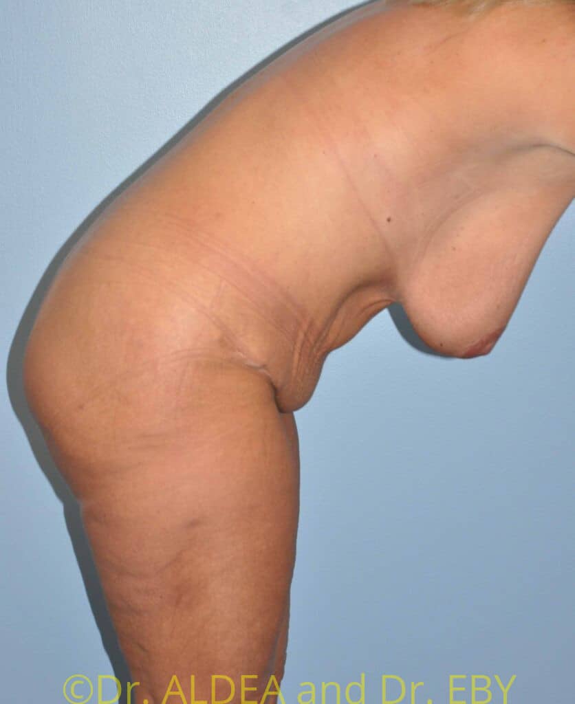 After Image: Tummy Tuck #289 - other