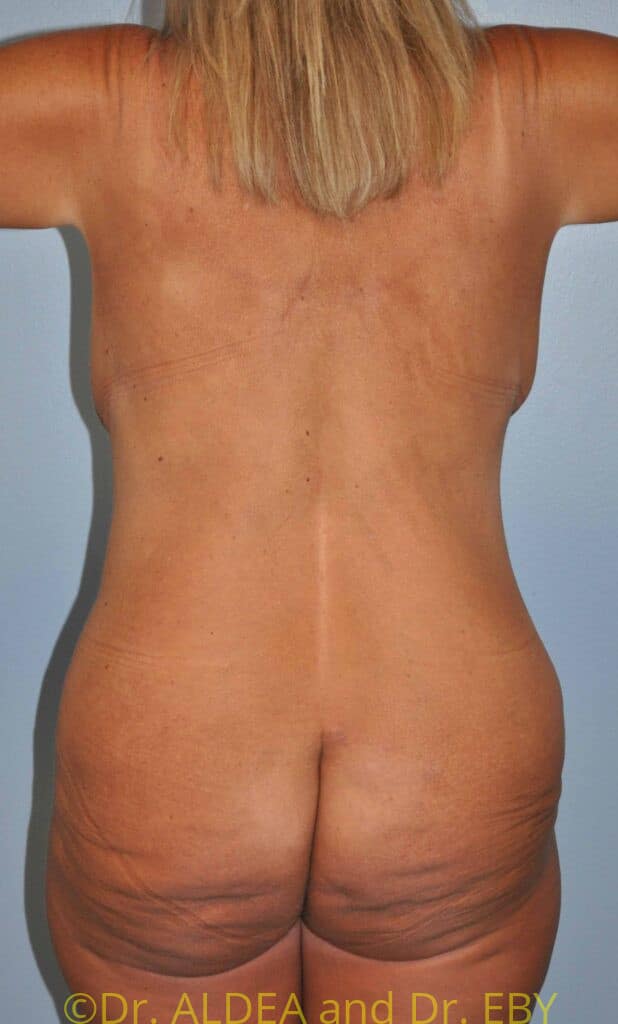 Before Image: Tummy Tuck #289 - back