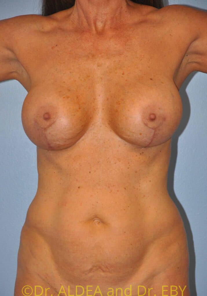 After Image: Breast Augmentation w/ Lift #617 - front
