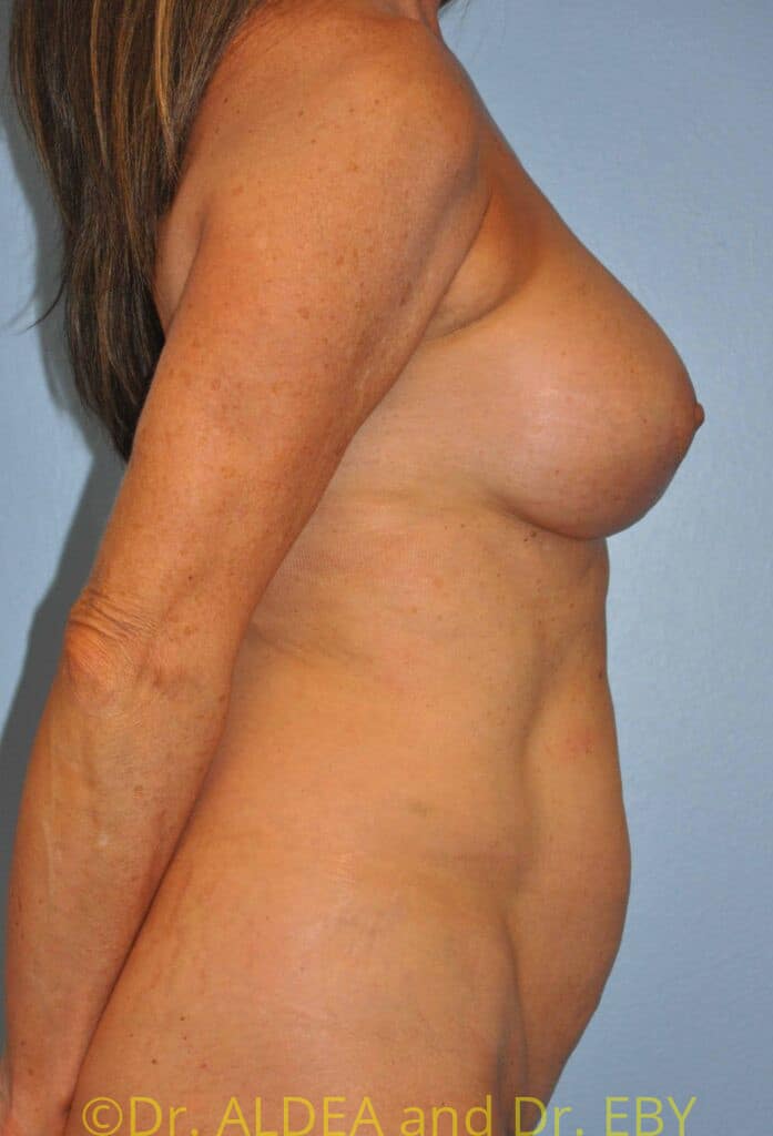 After Image: Breast Augmentation w/ Lift #617 - right-side