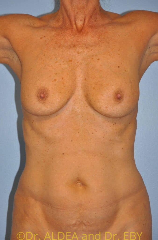 Before Image: Breast Augmentation w/ Lift #617 - front