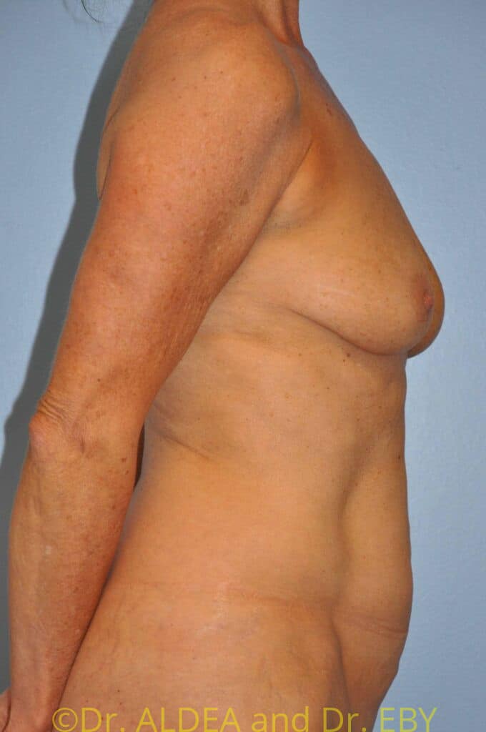 Before Image: Breast Augmentation w/ Lift #617 - right-side