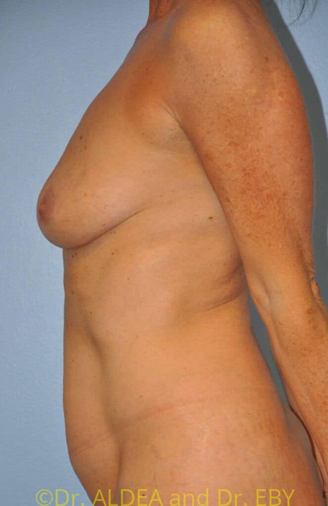 Before Image: Breast Augmentation w/ Lift #617 - left-side