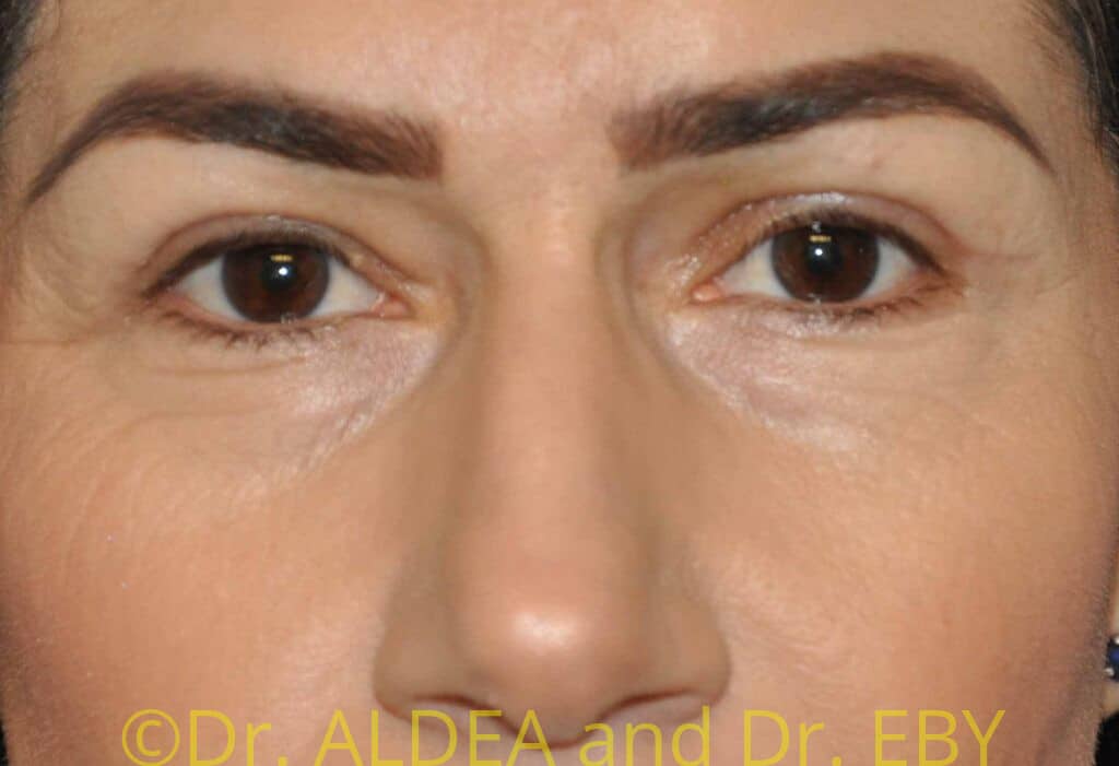 After Image: Blepharoplasty #111 - front