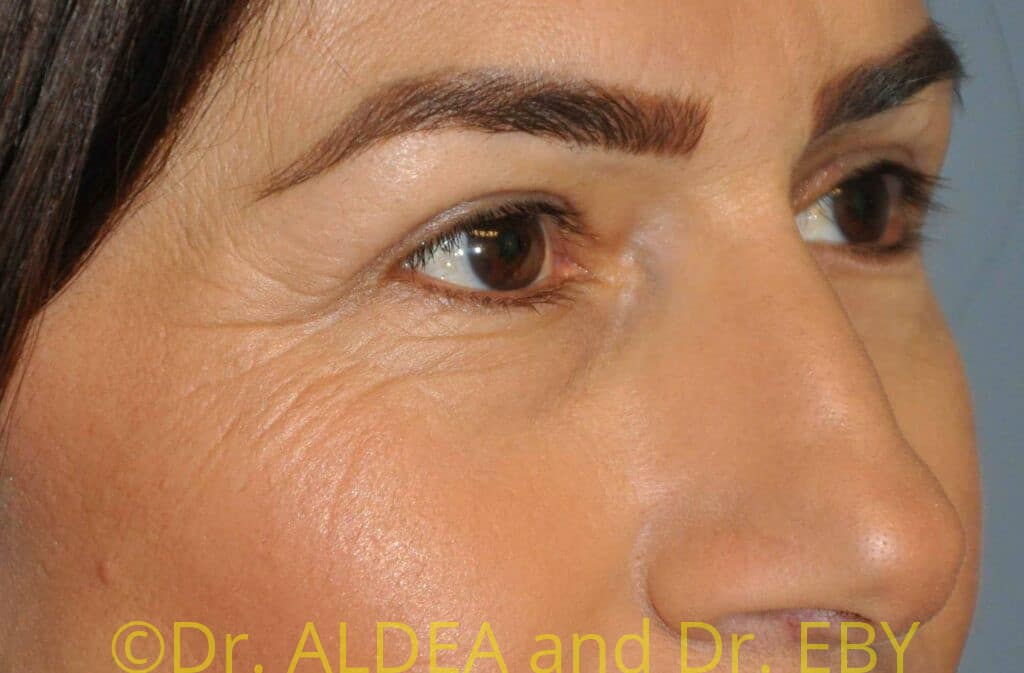 After Image: Blepharoplasty #111 - right-front-oblique