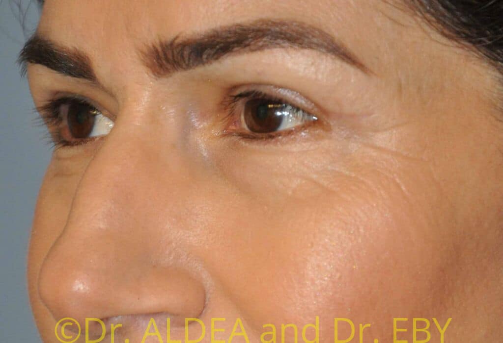After Image: Blepharoplasty #111 - left-front-oblique