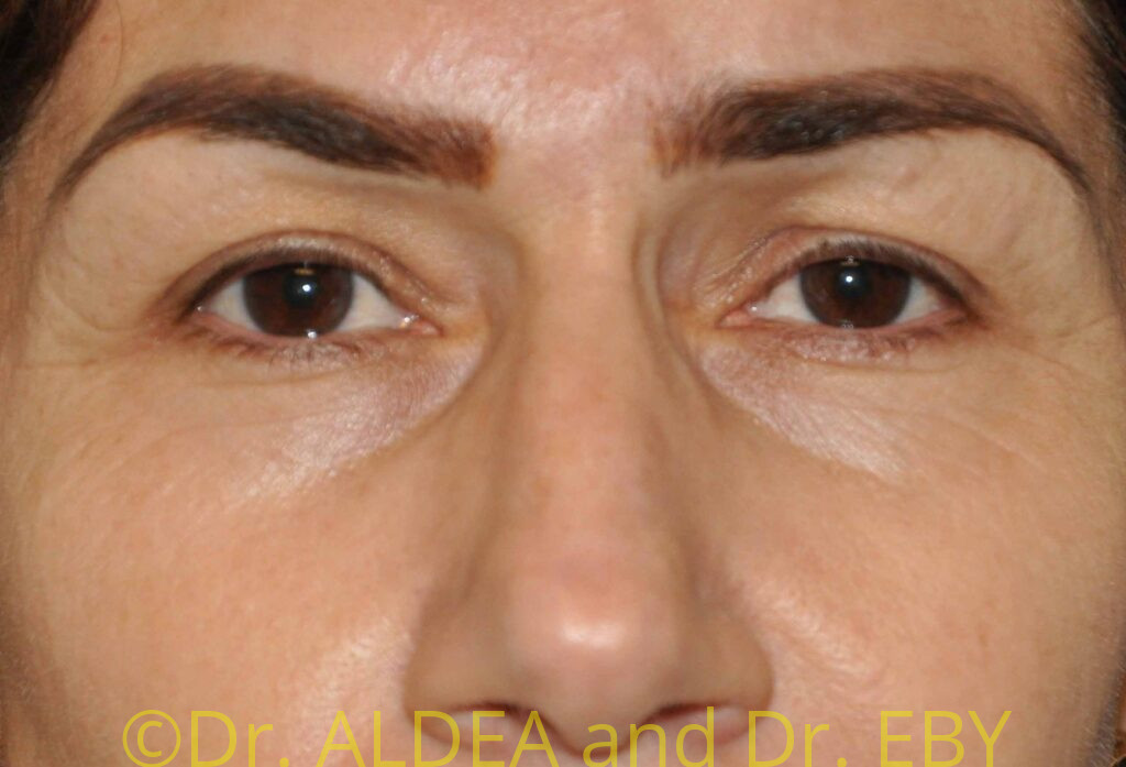 Before Image: Blepharoplasty #111 - front