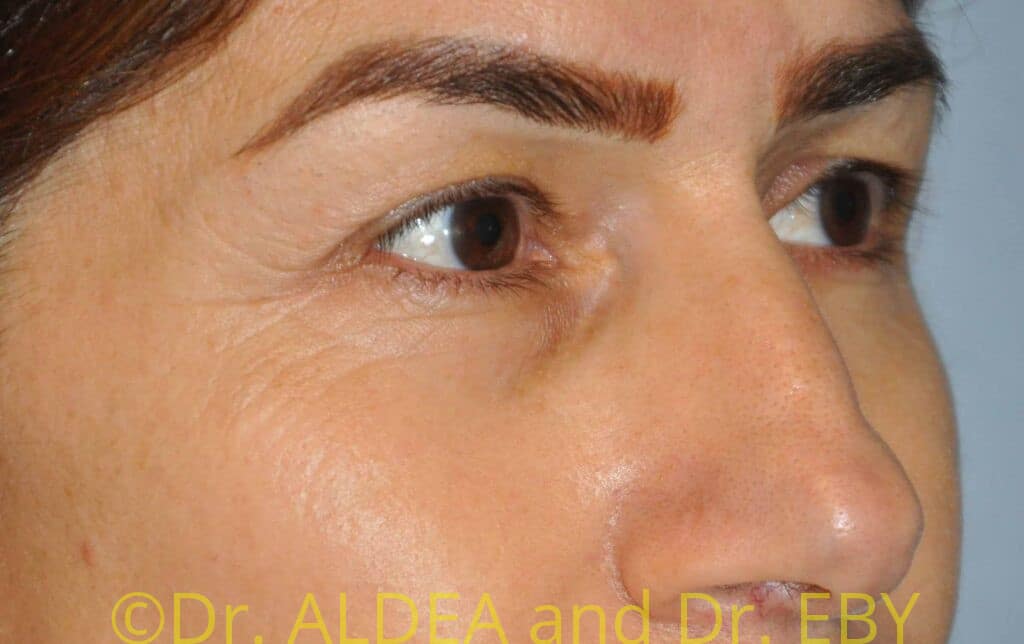 Before Image: Blepharoplasty #111 - right-front-oblique