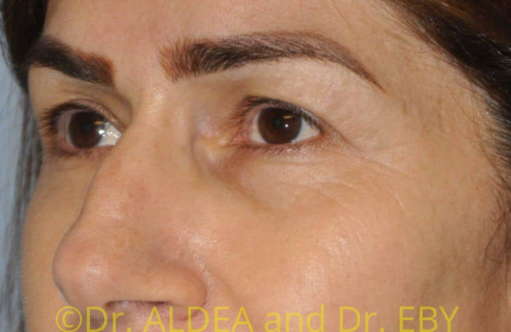 Before Image: Blepharoplasty #111 - left-front-oblique