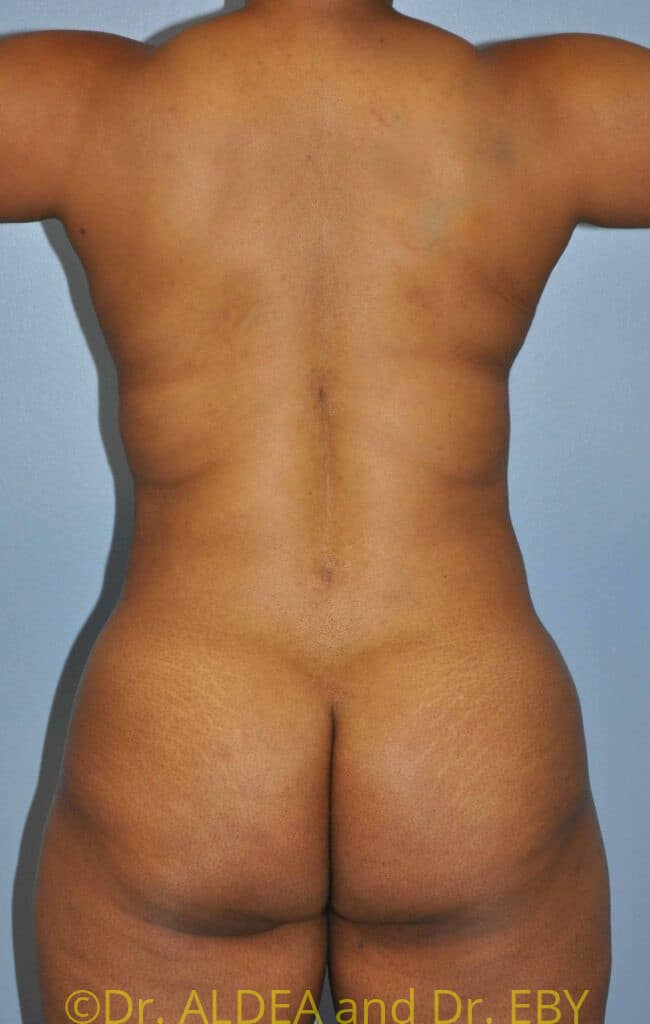 After Image: Back Scoop Liposuction #602 - back