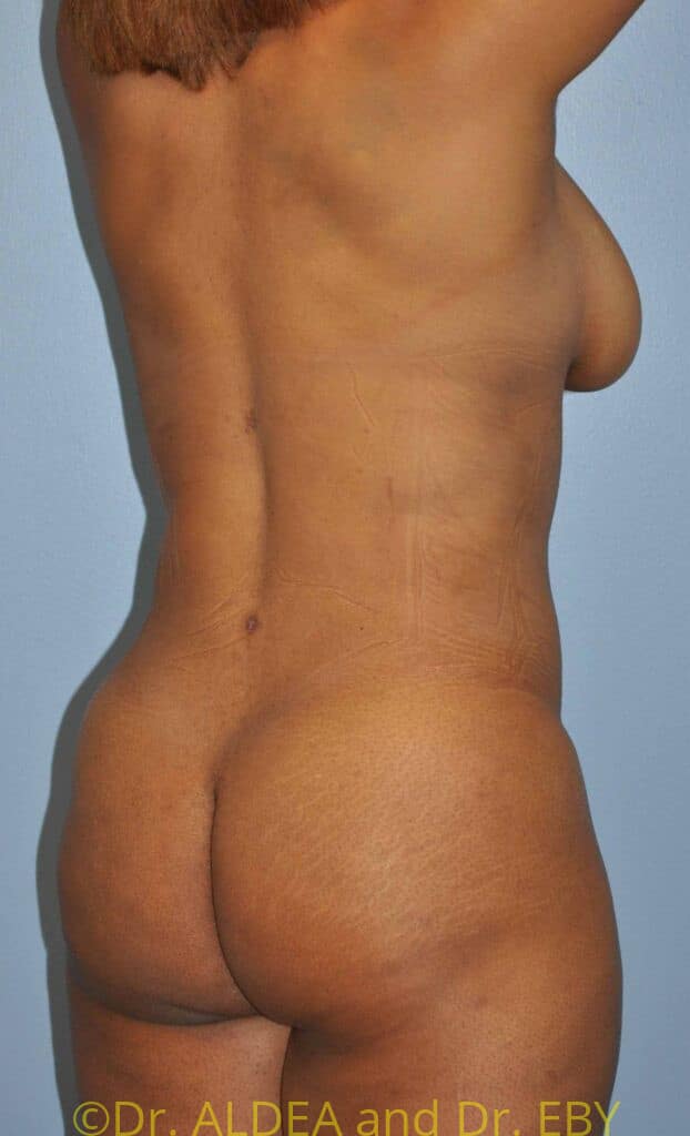 After Image: Back Scoop Liposuction #602 - right-back-oblique