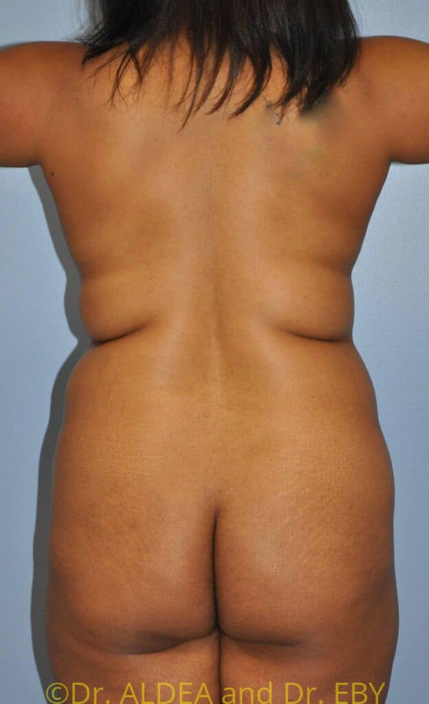 Before Image: Back Scoop Liposuction #602 - back