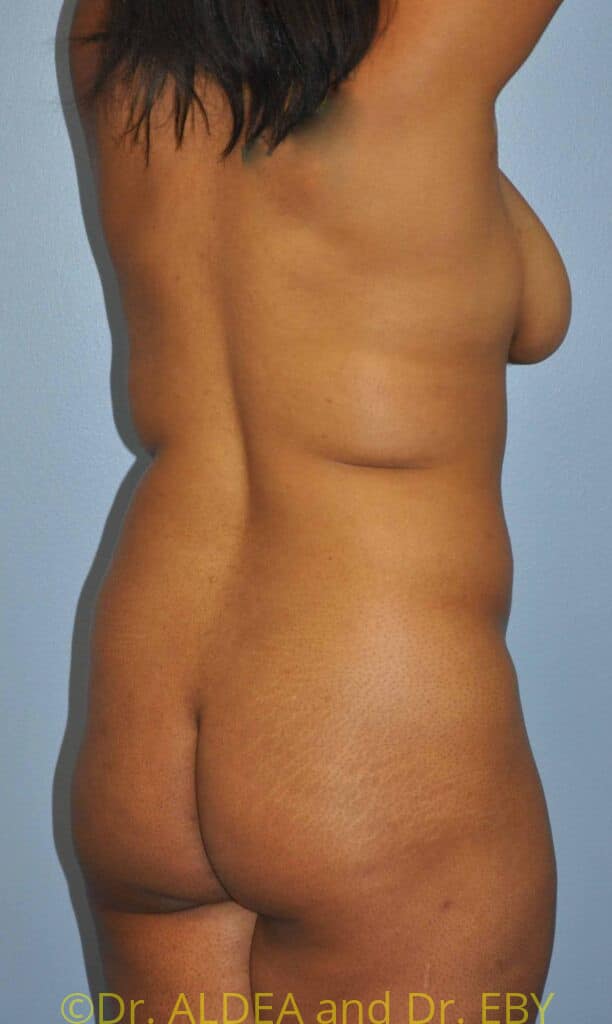 Before Image: Back Scoop Liposuction #602 - right-back-oblique