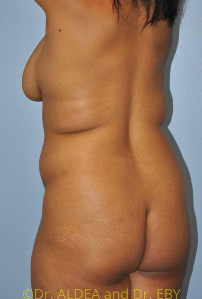 Before Image: Back Scoop Liposuction #602 - left-back-oblique