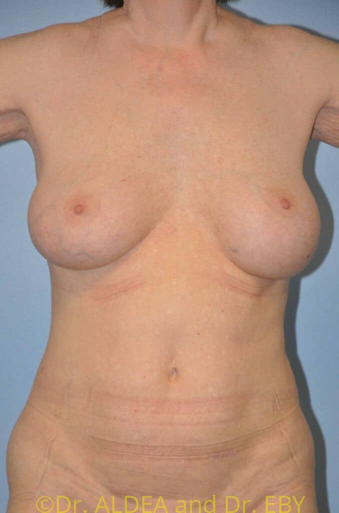 Before Image: Breast Implant Exchange with Lift #140 - front