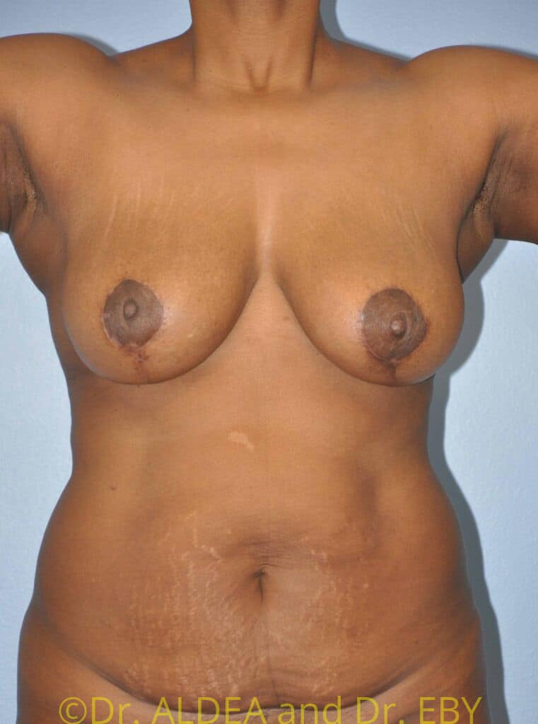 After Image: Short Scar Breast Lift (Mastopexy) #184 - front