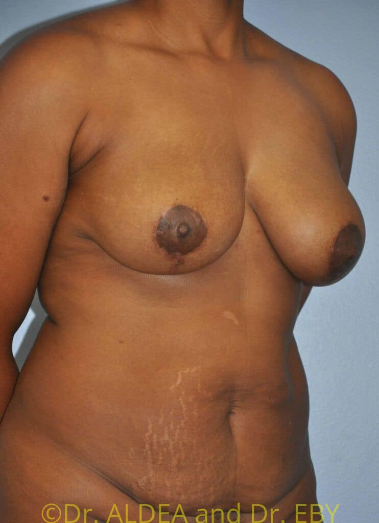 After Image: Short Scar Breast Lift (Mastopexy) #184 - right-front-oblique