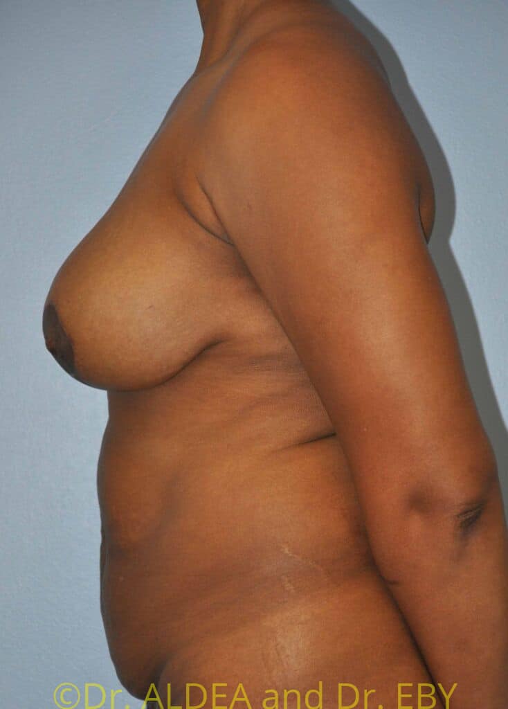 After Image: Short Scar Breast Lift (Mastopexy) #184 - left-side