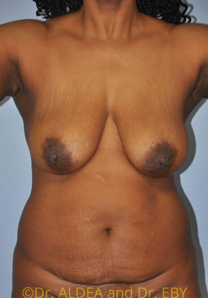 Before Image: Short Scar Breast Lift (Mastopexy) #184 - front