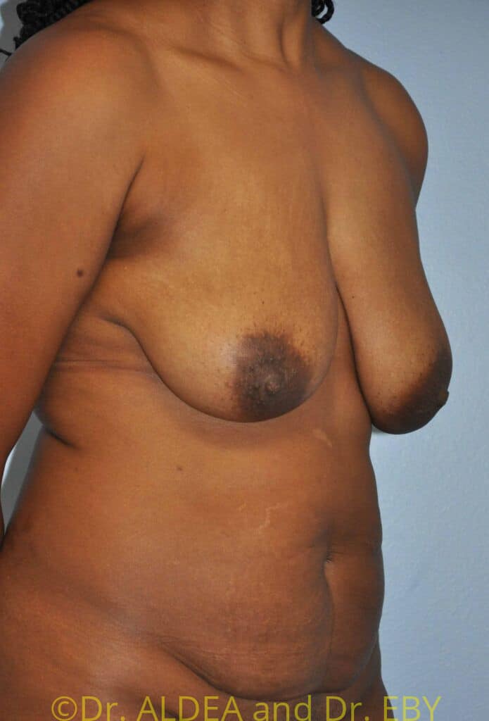 Before Image: Short Scar Breast Lift (Mastopexy) #184 - right-front-oblique